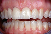 Zwei vollkeramische Frontzahnkronen (mittlere Schneidezähne) und zwei Veneers auf seitlichen Schneidezähnen